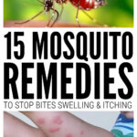 Mosquito Bite Remedies To Stop Swelling & Itching