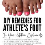DIY Athletes Foot Remedies