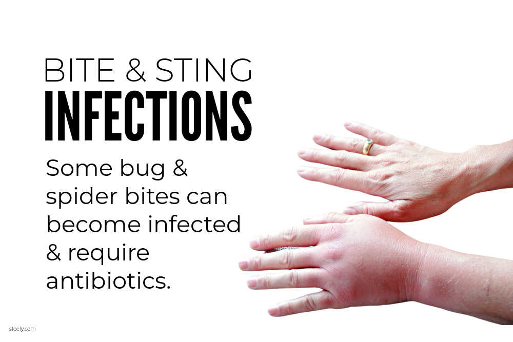 Bite And Sting Infections