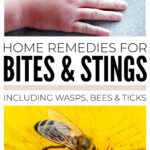 Home Remedies For Bites And Stings