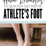 Athlete's Foot Home Remedies