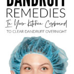 Best Home Remedies To Clear Dandruff Overnight