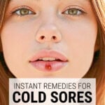 Young woman with cold sore on lips