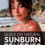 Young woman with sunburn on beach
