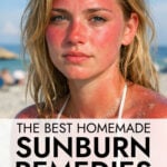 Young woman on beach with bad sunburn