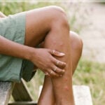 Young woman scratching leg with mosquito bites