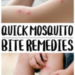 Collage of mosquito bites on arm and leg