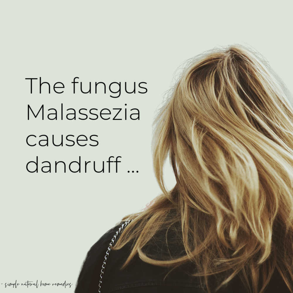 Dandruff Is Caused By The Malassezia Fungus