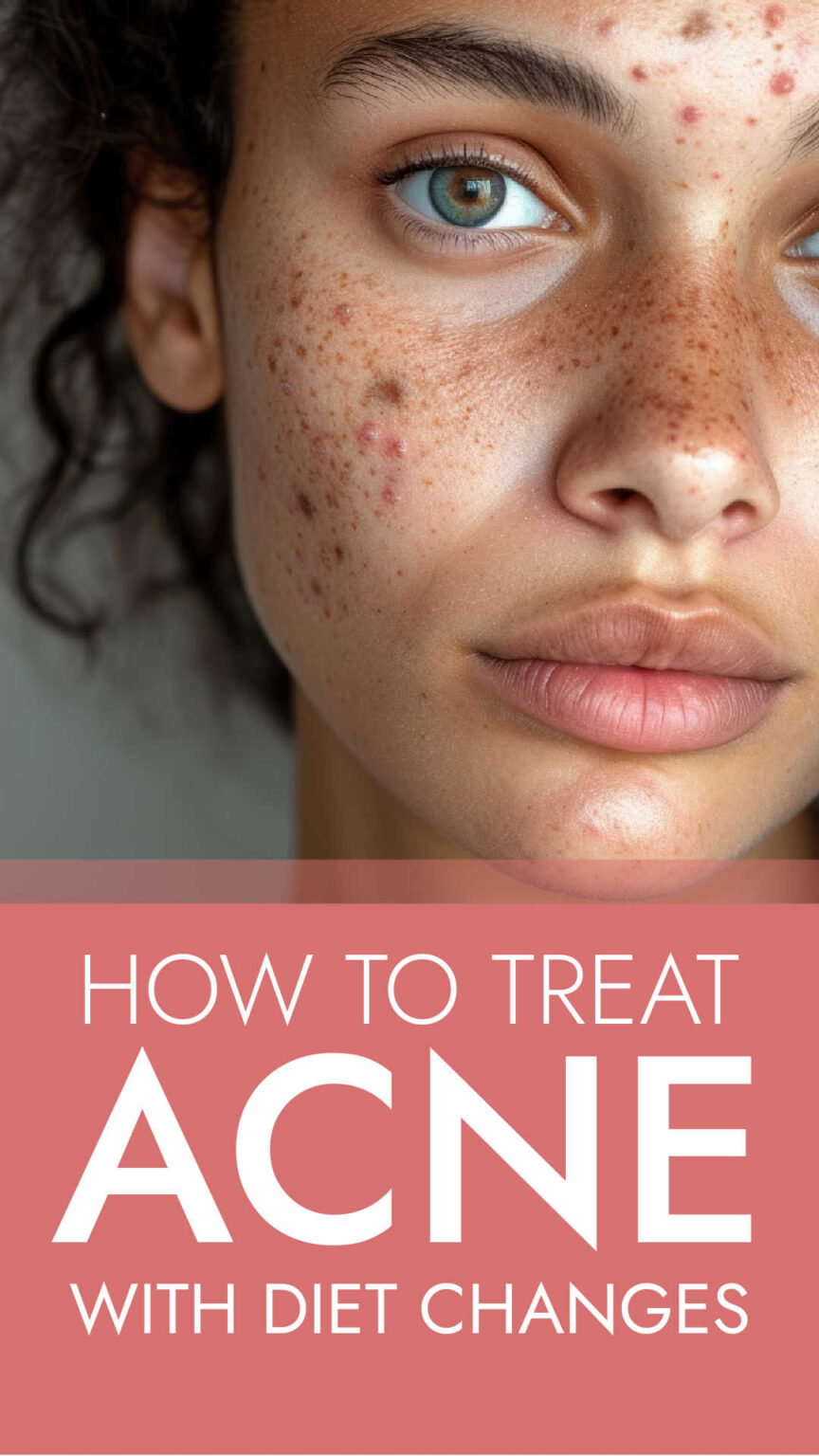Image showcasing Treating Acne With Diet