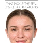 Young woman with acne