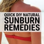 Sunburned woman on beach wearing red bikini