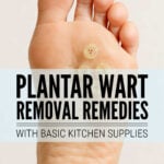 Woman's foot with plantar warts