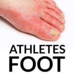 A foot with the athlete's foot fungal infection