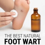 Plantar wart on sole of foot being dabbed with a cotton wool ball of ointment from an amber bottle.