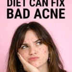 A young woman with acne