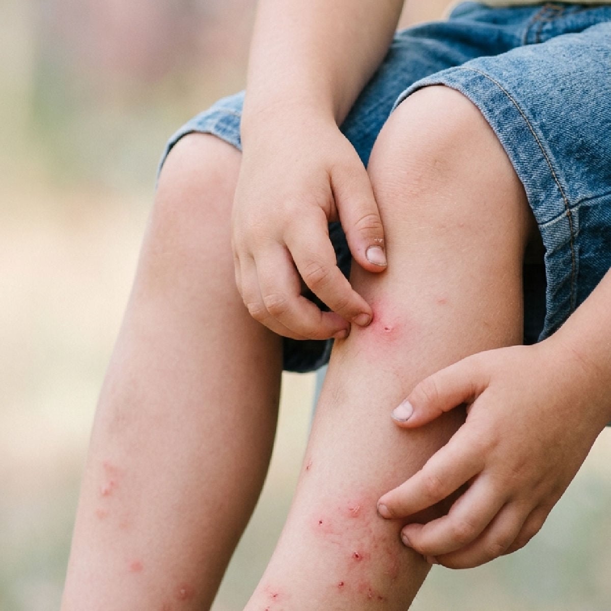 Boy scratching mosquito bites
